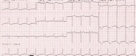 lvh with strain pattern meaning.